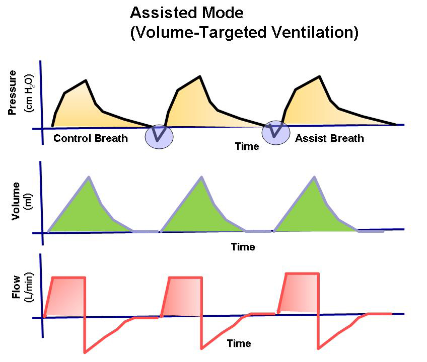 EmergenMed Health Blog Ventilación mecánica