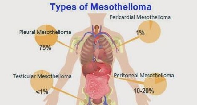 Mesothelioma Metastasis