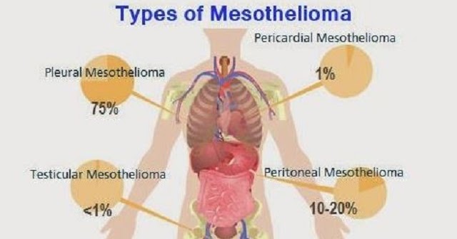 mesothelioma psammoma bodies