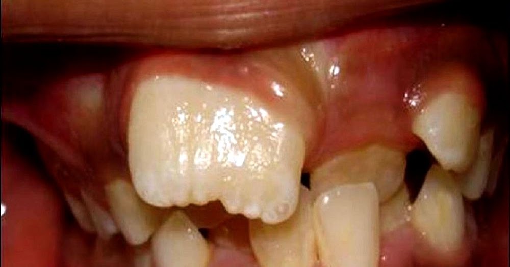 oral pathology Oral pathology clinical review 4 credit hours (4 ces) materials from united states air force 2013 instructional materials in the public domain for dental professionals. oral pathology Oral pathology clinical review 4 credit hours (4 ces) materials from united states air force 2013 instructional materials in the public domain for dental professionals.