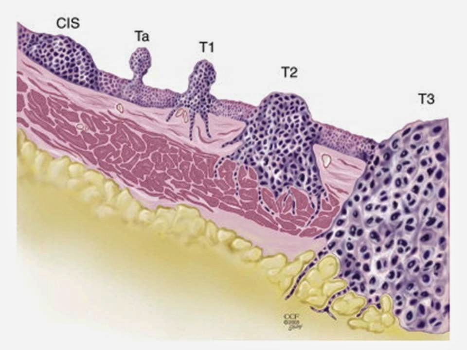 Brady Urology at Johns Hopkins Hospital: Carcinoma In Situ of the