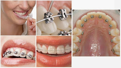 Răng mọc lệch vào trong điều trị như thế nào?
