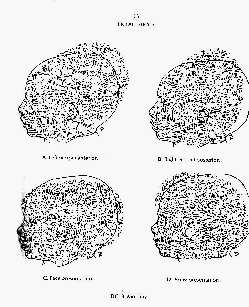 Birth Positions and Desseauve 2017 Spinning Babies