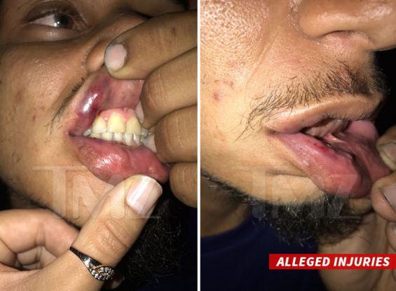 0417 chris brown victim injuries tmz wm 3 Chris Brown accused of punching photographer in nightclub brawl (photos)