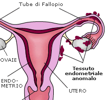 Endometriosi: problema riguarda milioni donne Italia