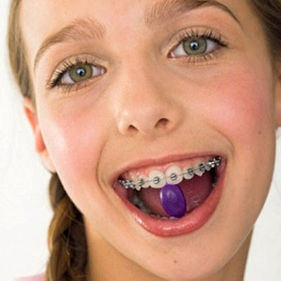Niềng răng ở lứa tuổi nào là hợp lý ?