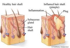cara mengatasi jerawat atau acne