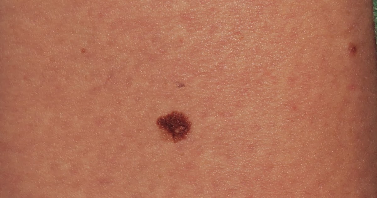 bestway: Melanoma Symptoms, Signs, Diagnosis, Staging, Prognosis and