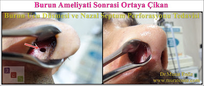 Nasal septum perforation closure in İstanbul, Turkey - Surgical treatment of nasal septal perforation in İstanbul - Open technique repair of nasal septal perforations in Turkey - Repair of nasal septal perforation - Septal perforation repair surgery