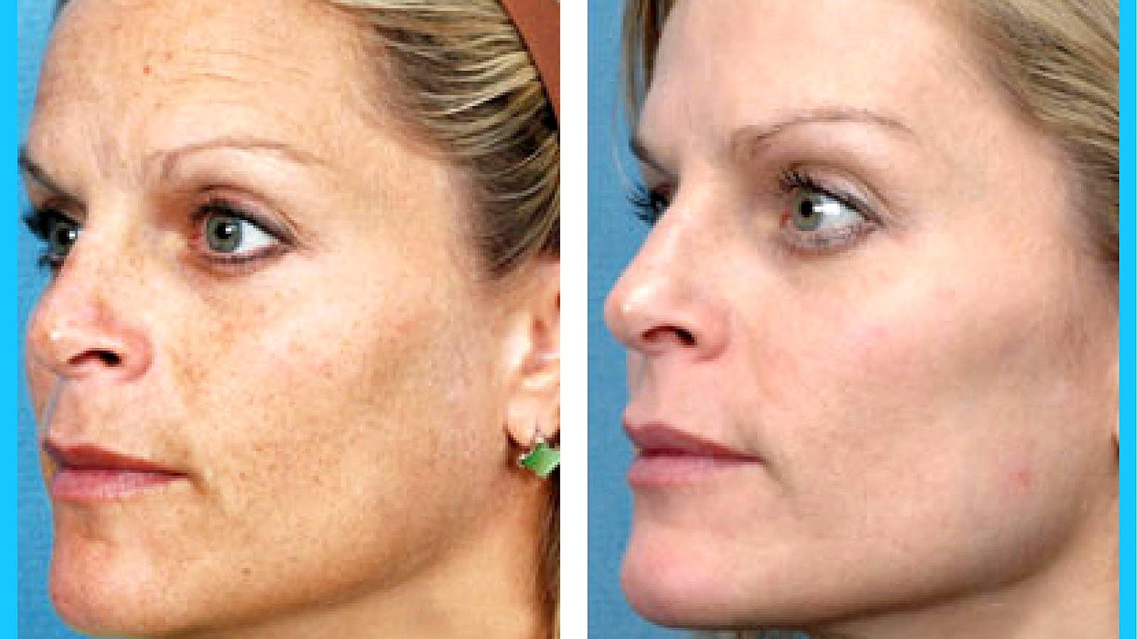 Clear And Brilliant Laser Treatment Treat Choices