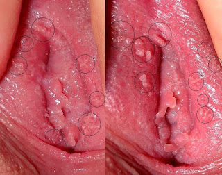 Tumbuh Daging Semacam Jerawat Di Vagina