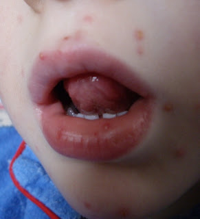chicken pox spots in mouth