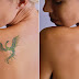 Top Queries About Laser Tattoo Removal