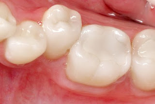 Trám răng mất thời gian bao lâu ? Trám răng mất thời gian bao lâu ?