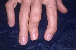 Psoriatic-arthritis