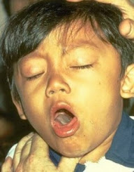 Pengobatan Batuk Kronis Pada Anak Pengobatan Batuk Kronis Pada Anak