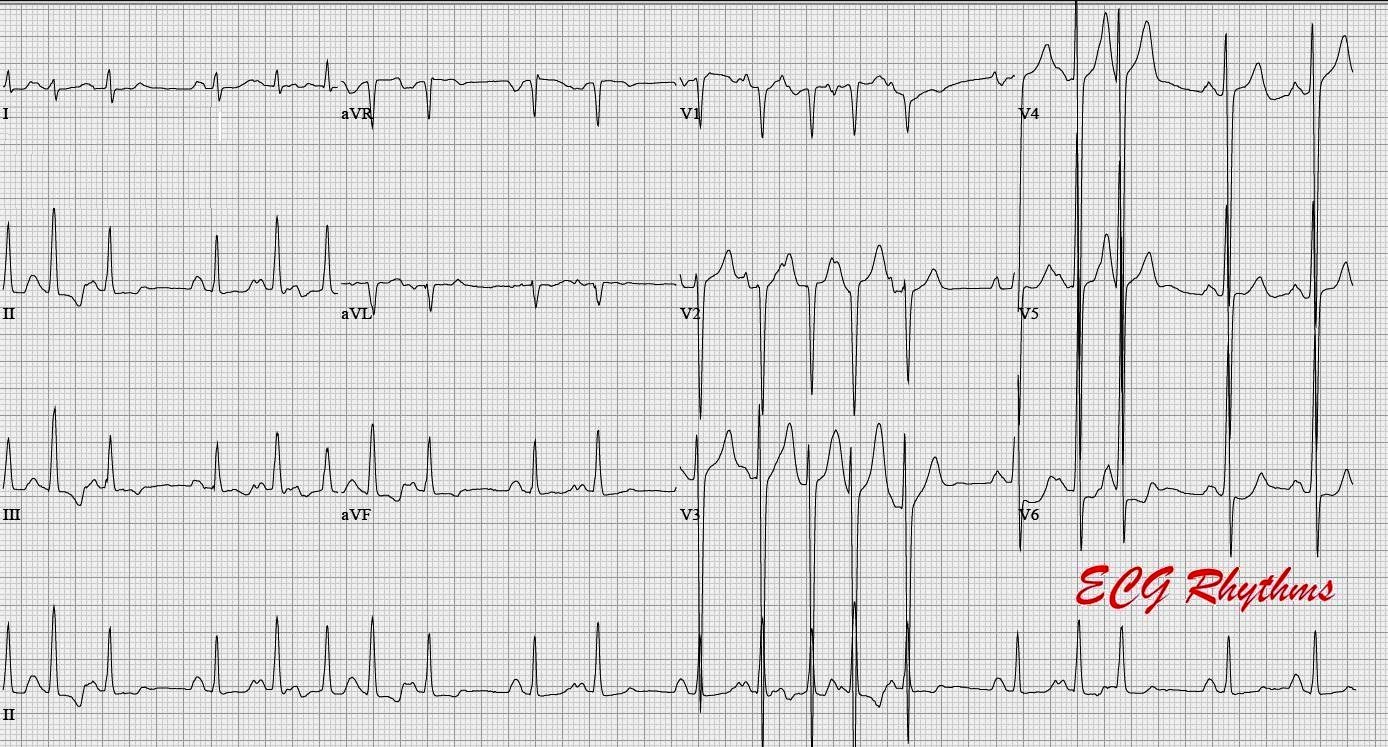 Экг при гиперкалиемии картинки