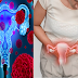 For all Women: Be Aware of Early Sign Of Ovarian Kanser