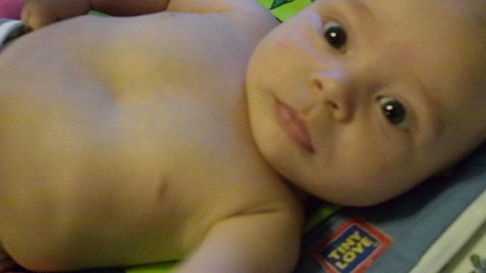 jared and alisa Pectus Excavatum