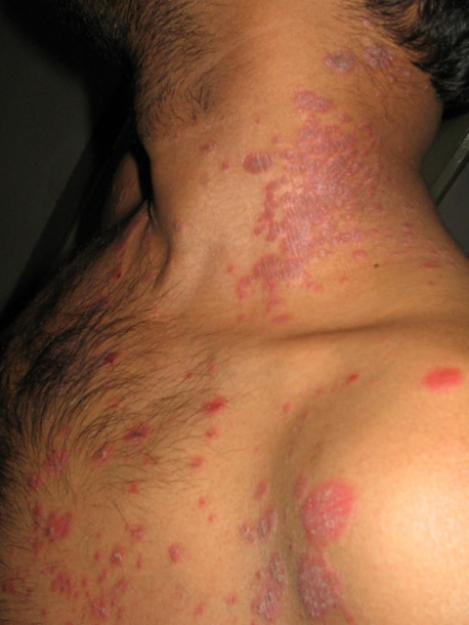 psoriasis painful)