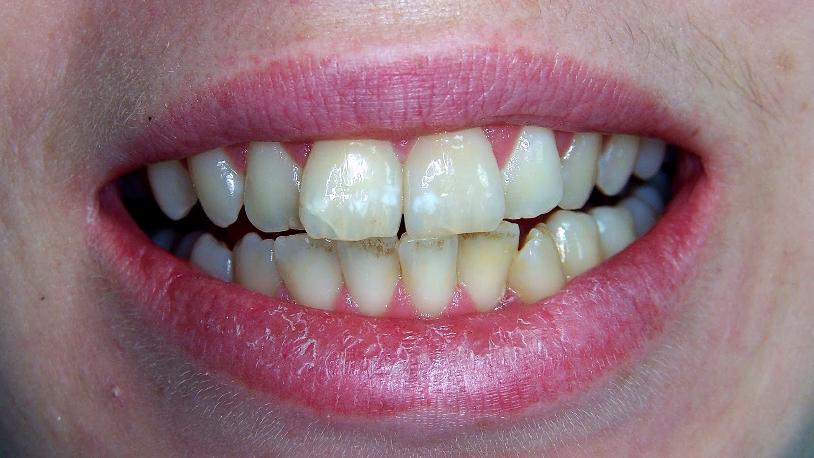 Teeth Bleaching Side Effects Effect Choices
