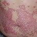obat eksim yg mujarab thumbnail