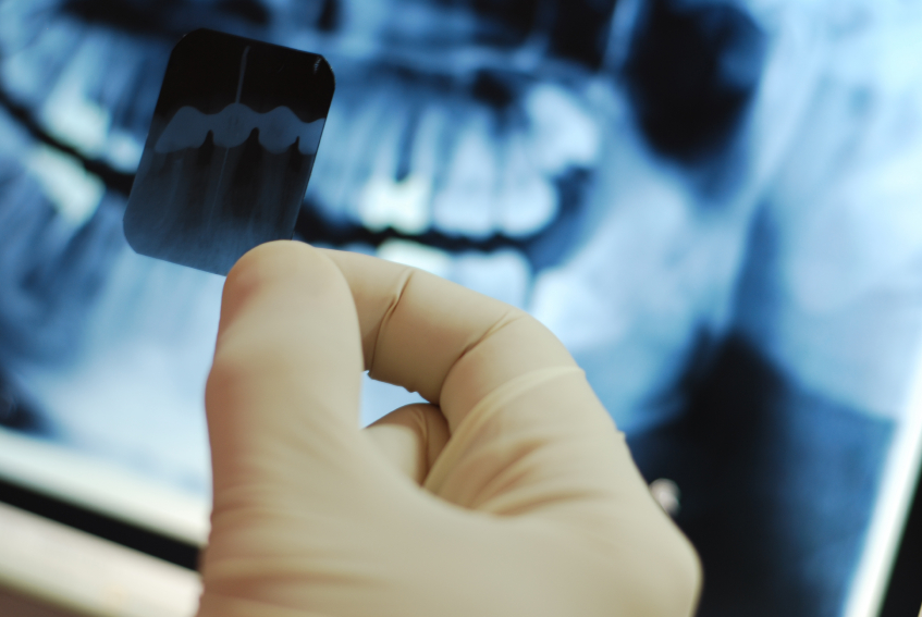 Deep Teeth Cleaning Panoramic Xray