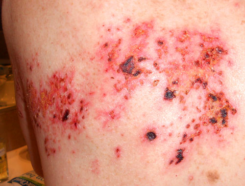 Shingles black scabs