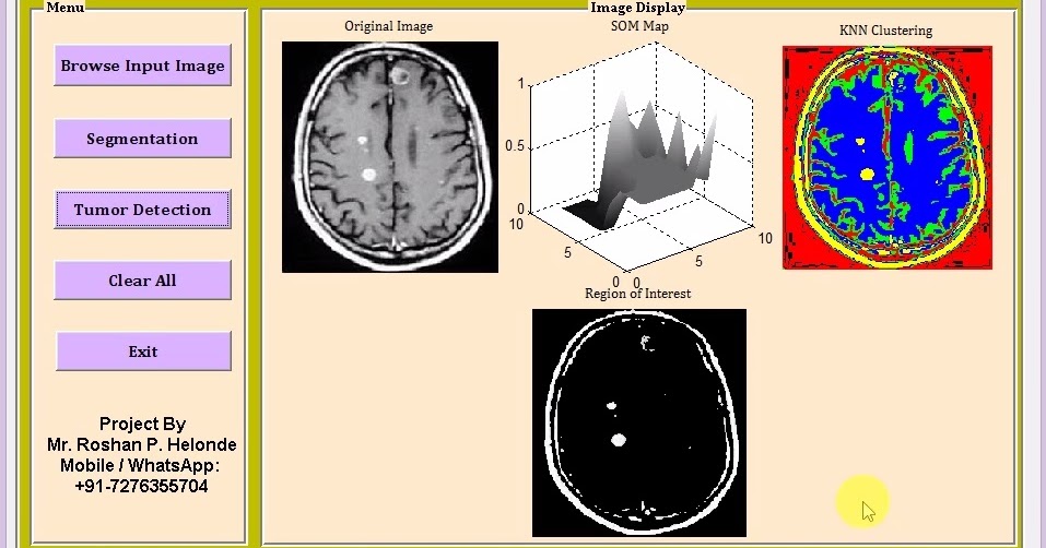 Brain tumor detection on mri images using segmentation and clustering