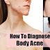 Body Acne Remedies - Get Rid of Back and Chest Acne