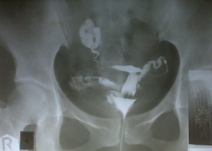 A Y A T " IQRA' BACALAH" Pemeriksaan HSG