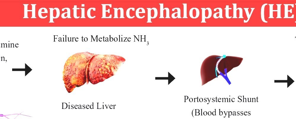 Hepatic Encephalopathy - Hepatic Encephalopathy Diet