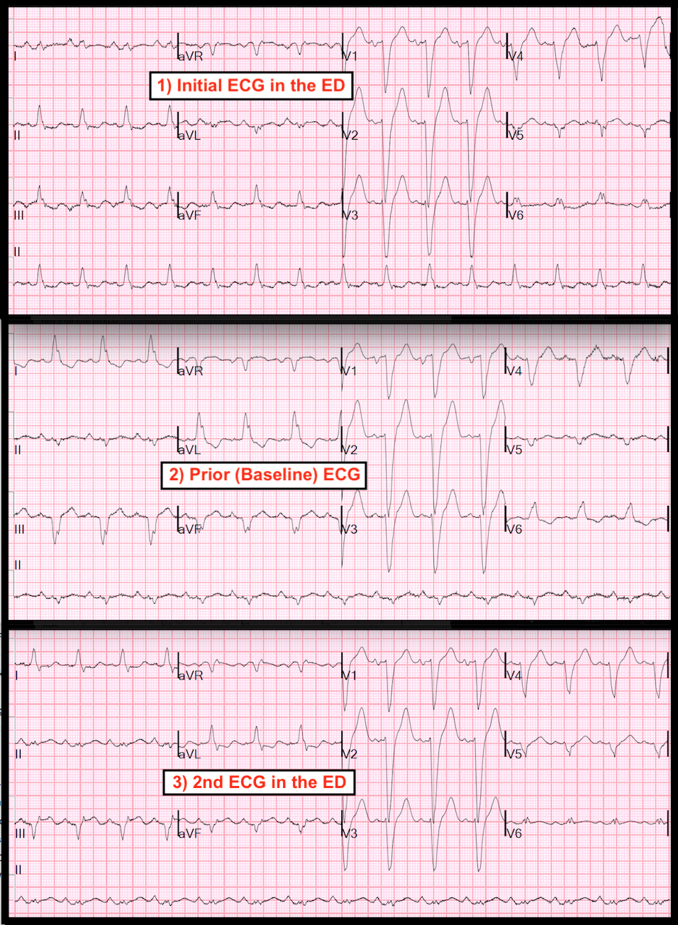 Dr. Smith's ECG Blog Left Bundle Branch Block, Severe Chest pain