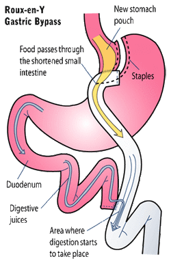 RNY Gastric Bypass