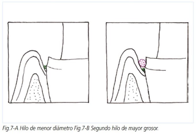 PDF: Técnicas de desplazamiento gingival en prótesis fija