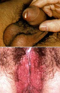 chlamydia symptoms on men and women