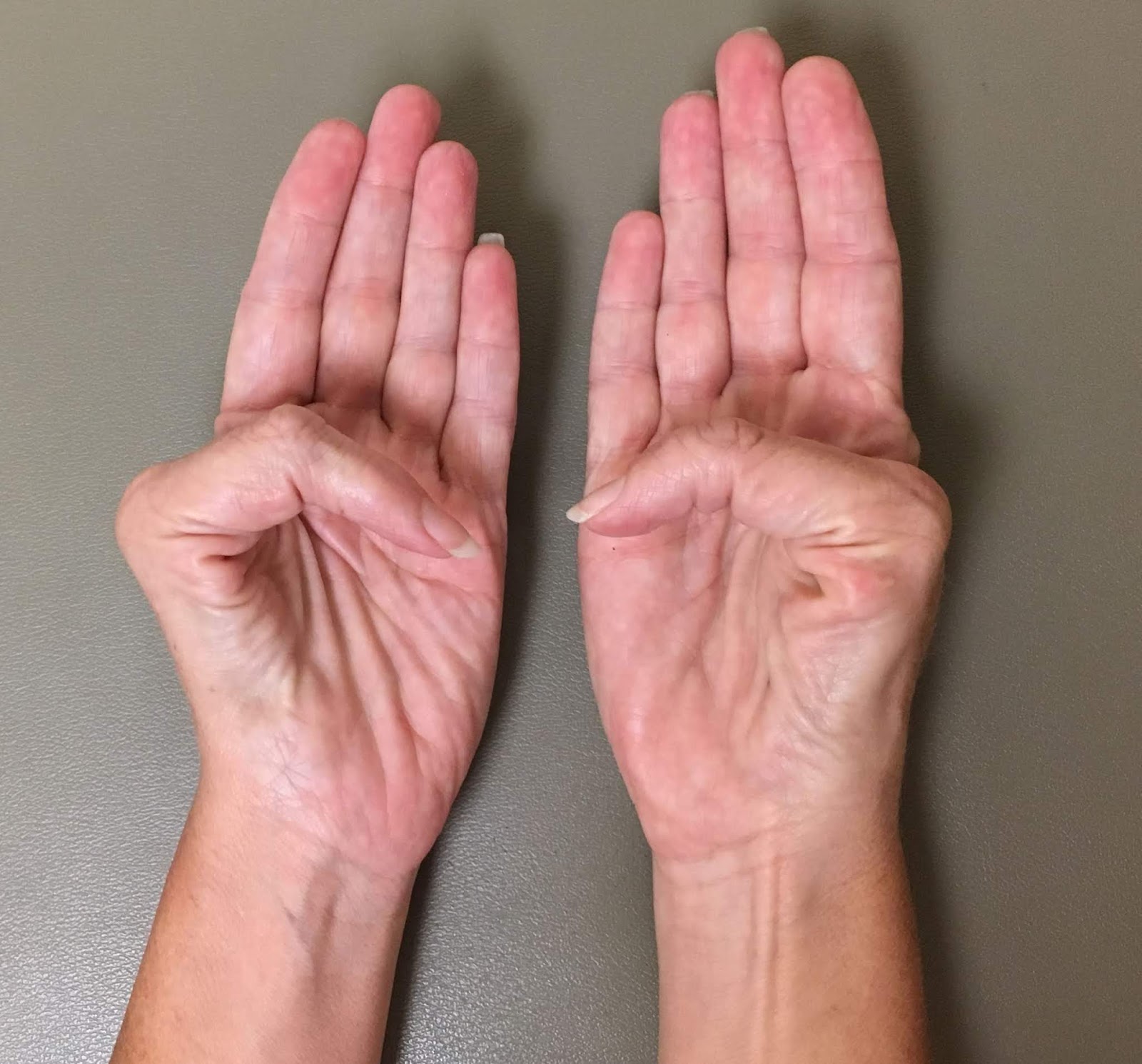 Families, Choices, and Untreated Triphalangeal Thumbs Congenital Hand