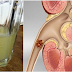 SAY GOODBYE TO YOUR KIDNEY STONES WITH ONLY HALF A CUP OF THIS DRINK