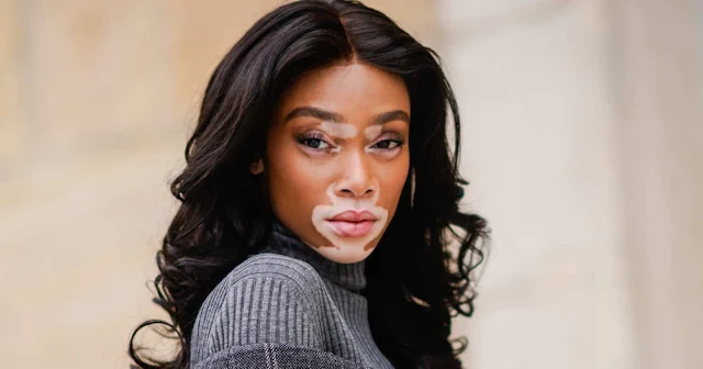 Winnie Harlow No Sufre Por El Vitíligo