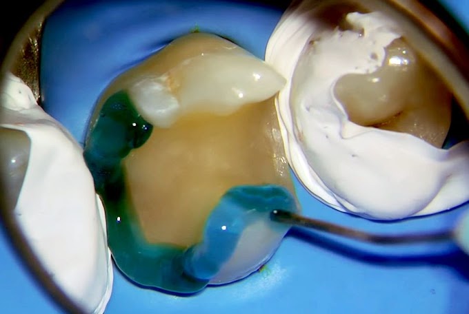 OPERATIVE DENTISTRY: Indirect Composite Restoration - Clinical Case