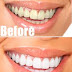 In 2 minutes, turn yellow teeth to pearl white