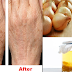 Woman Removed The Brown Spots On Her Hands By Simply Using This Cream!