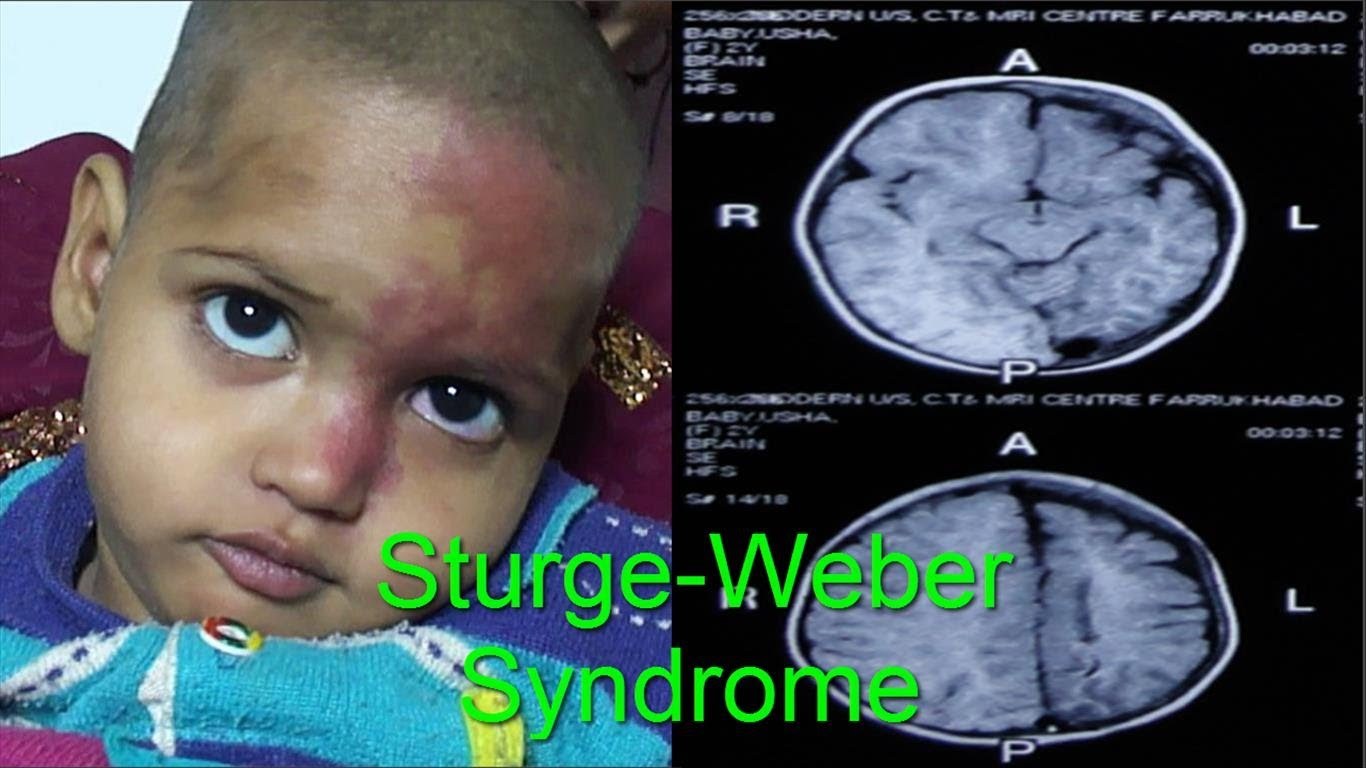 SturgeWeber syndrome SturgeWeber syndrome