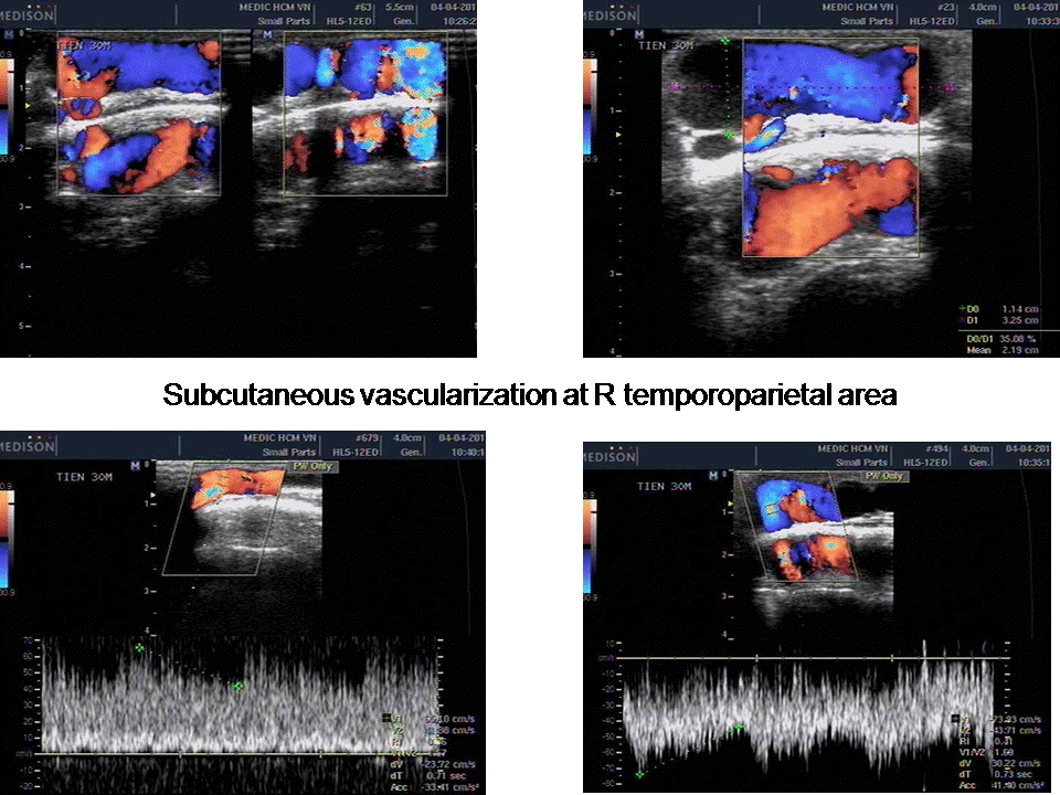 VIETNAMESE MEDIC ULTRASOUND CASE 180 AV FISTULA POST OP MIDDLE EAR