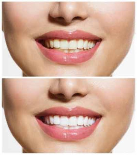 Dental Veneers and Teeth Whitening are Bringing New Smiles to Many