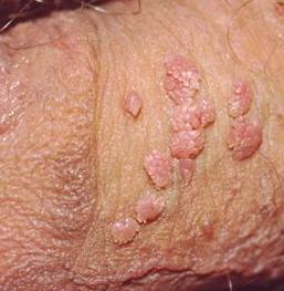 Cara Mengatasi Penyakit Hpv