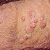 Gejala Hpv thumbnail