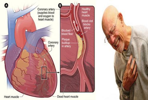 MSD priručnik dijagnostike i terapije: Dilatativna kongestivna kardiomiopatija