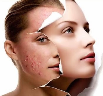 TCA CROSS for acne scars