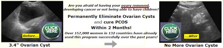 Ovarian cysts can mean cancer of the ovary
